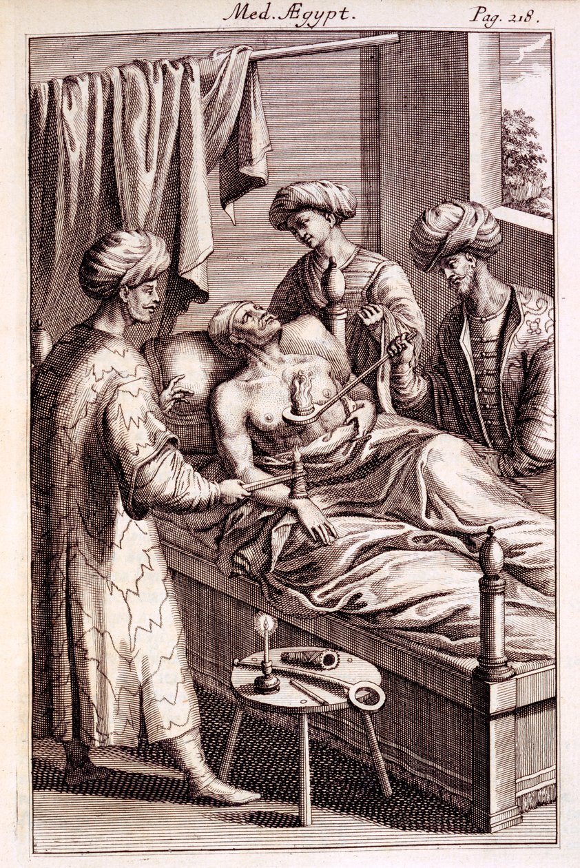 Illustrasjon av moxibustion fra Medicina Aegyptorum av Prospero Alpinus, 1745 av American School