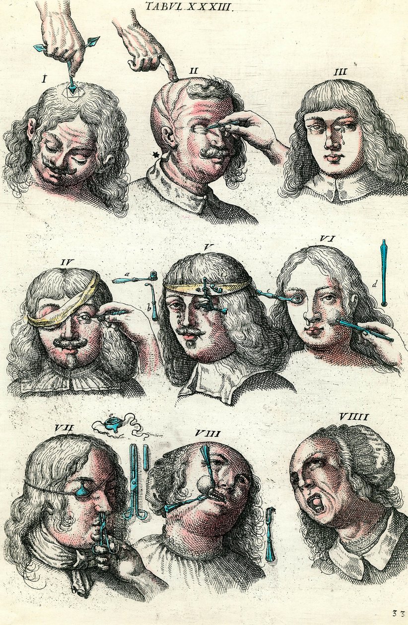 Kirurgi på 1700-tallet: Trepanasjon og operasjon av øyet og ansiktet. Gravering i "Institutionis chirurgicae" av Lorenzo Heister av Anonymous Anonymous