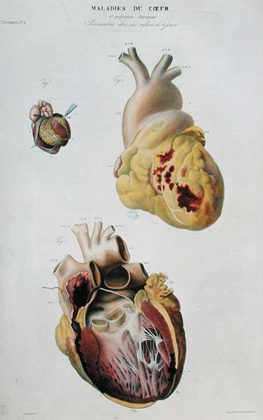 Plate som viser hjertesykdommer. Spontan ruptur av hjertet til en 86 år gammel kvinne (fig. 1) og perikarditt hos en seks dager gammel baby (fig. 2), fra 