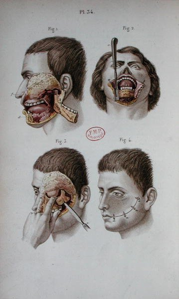 Anatomisk plate av overkjeven av C and Huette E. Bernard
