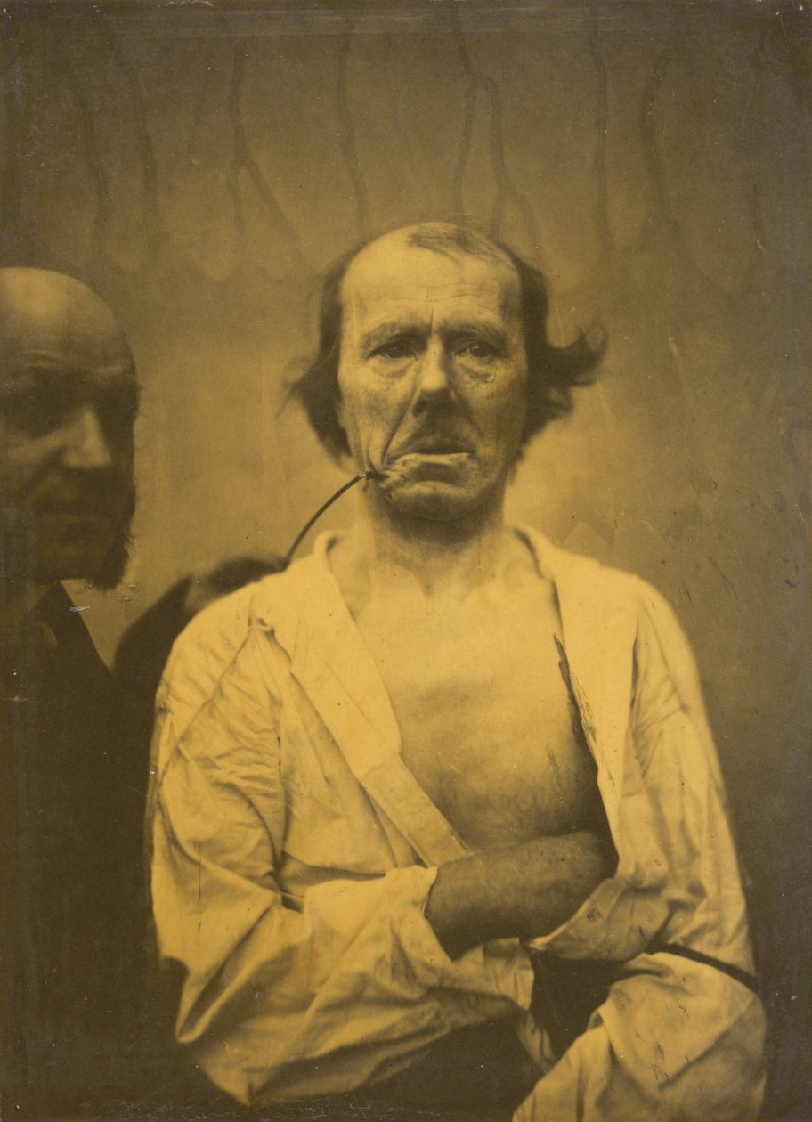 Et avslappet uttrykk til venstre, Avsky til høyre, 1854-1856, trykt 1862. av Duchenne de Boulogne