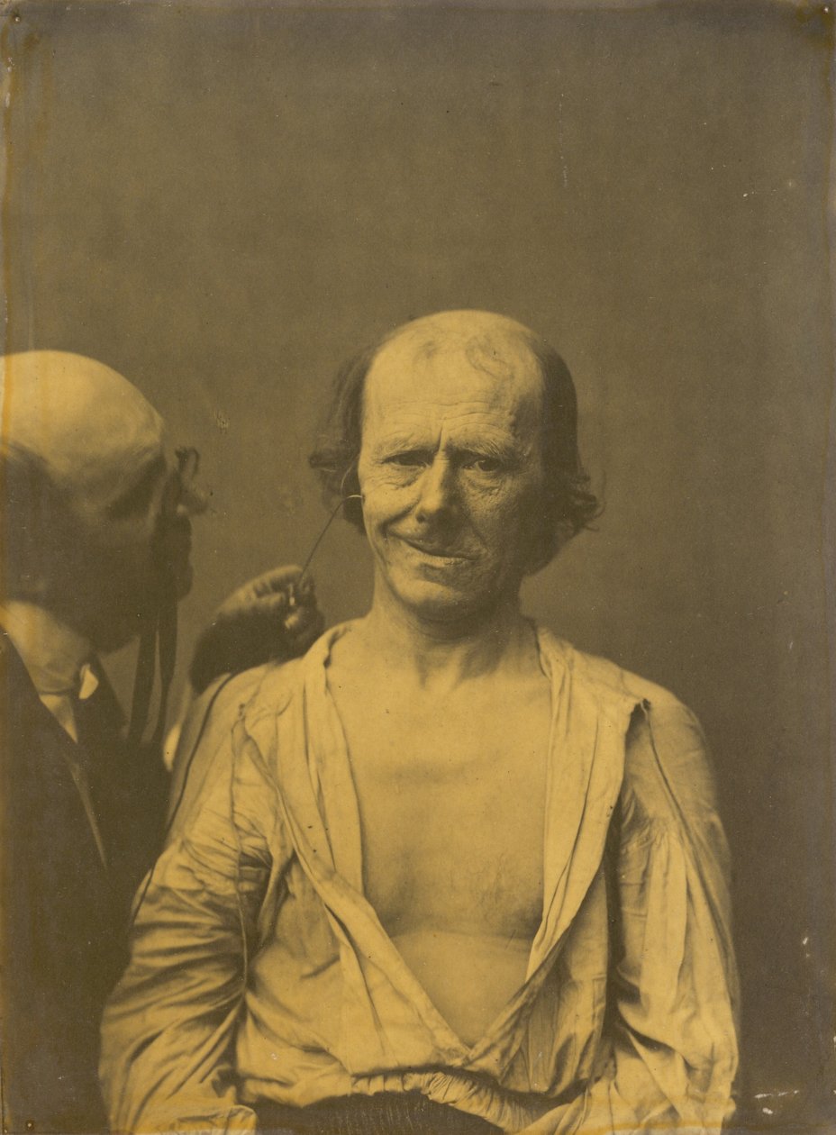 Et avslappet ansikt venstre, falsk glede eller latter høyre, 1854-1856, trykt 1862. av Duchenne de Boulogne