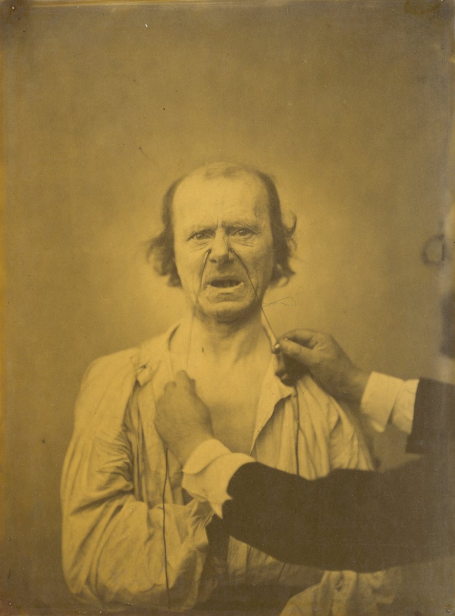 Misnøye, dårlig humor, 1854-1856, trykt 1862. av Duchenne de Boulogne