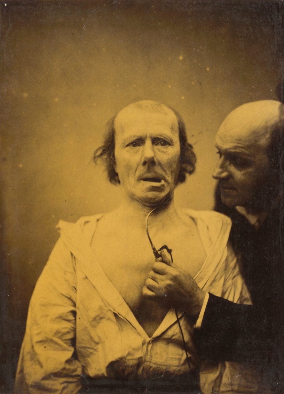 Denne sammentrekningen av m. platysma alene mangler uttrykk, 1854-1856, trykt 1862. av Duchenne de Boulogne
