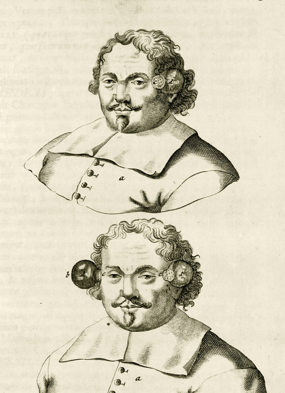Et eksempel på kopping, fra The Practice of Medicine av Frederik Dekkers, 1694 av Dutch School