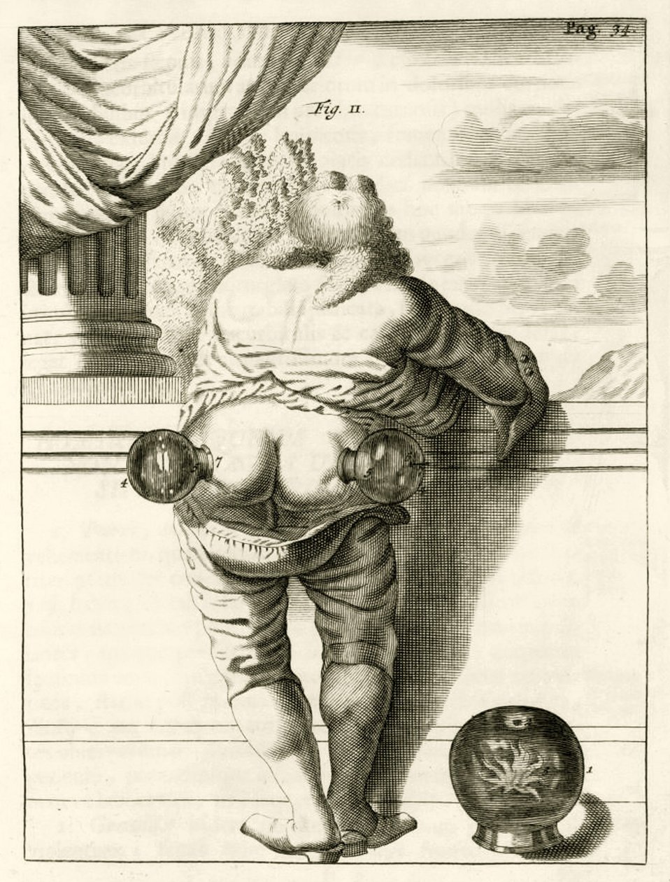 Et eksempel på kopping, fra The Practice of Medicine av Frederik Dekkers, 1694 av Dutch School
