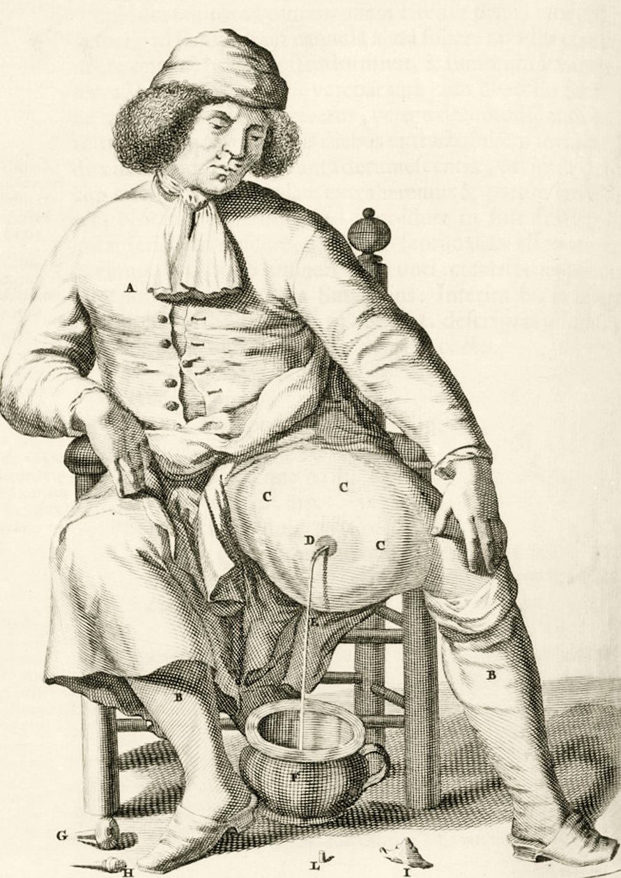 Drenering av væske fra en abscess av Frederik Dekkers, 1694 av Dutch School