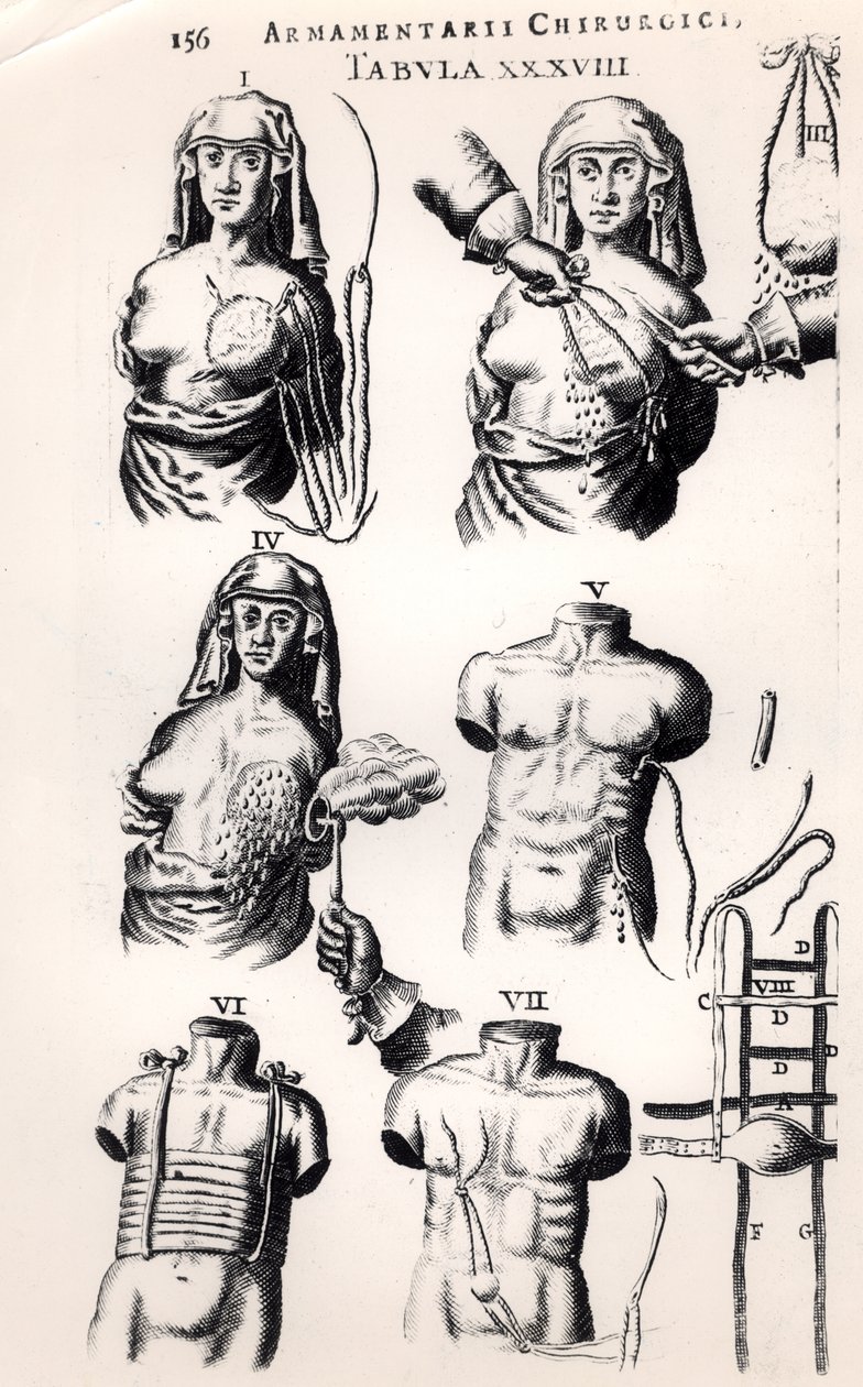 Opererer på brystkreft, fra Armamentarii Chirurgici av Johannes Schultes (1595-1645) utgitt i Amsterdam, 1672 av Dutch School