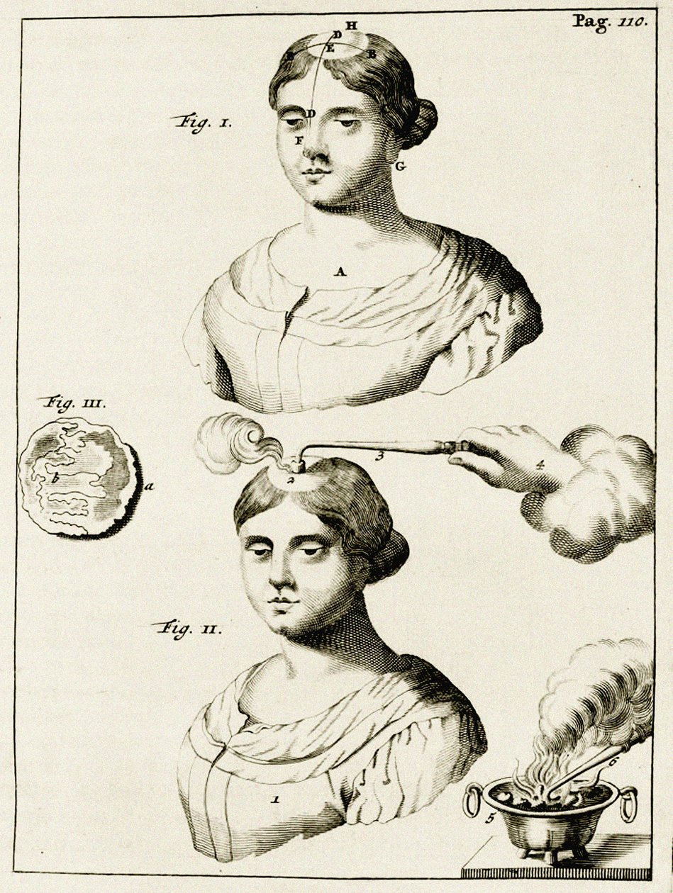 Behandling av en lider av epilepsi, fra Exercises in the Practice of Medicine av Frederik Dekkers, 1694 av Dutch School