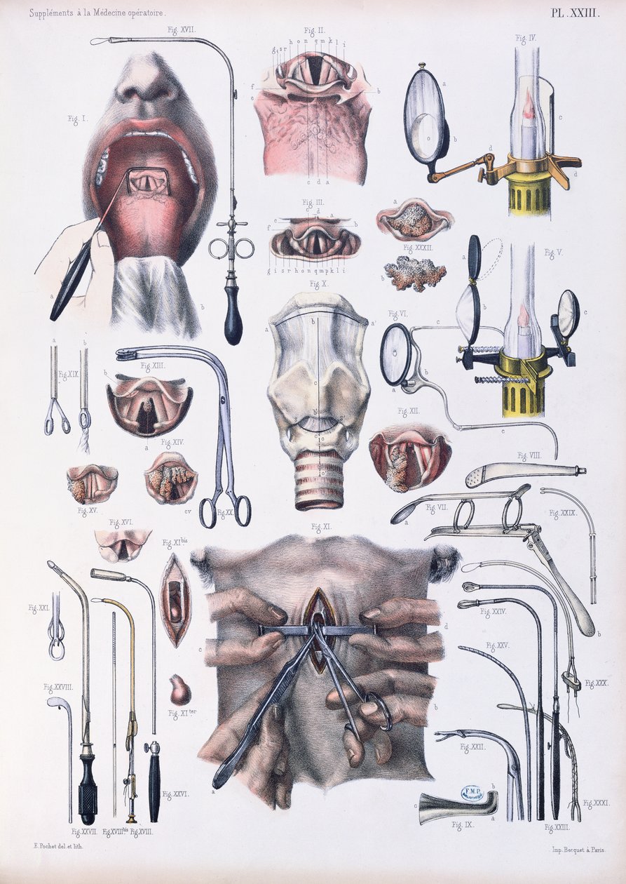 Trakeotomioperasjon, plate fra 