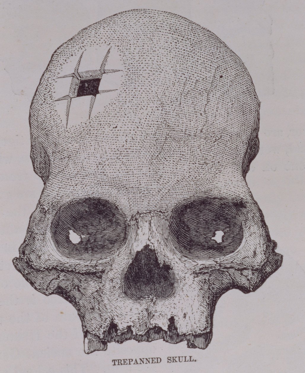 Trepanned Skull, fra «Incidents of Travel and Exploration in the Land of the Incas» av E. George Squier, pub. i 1878 av English School