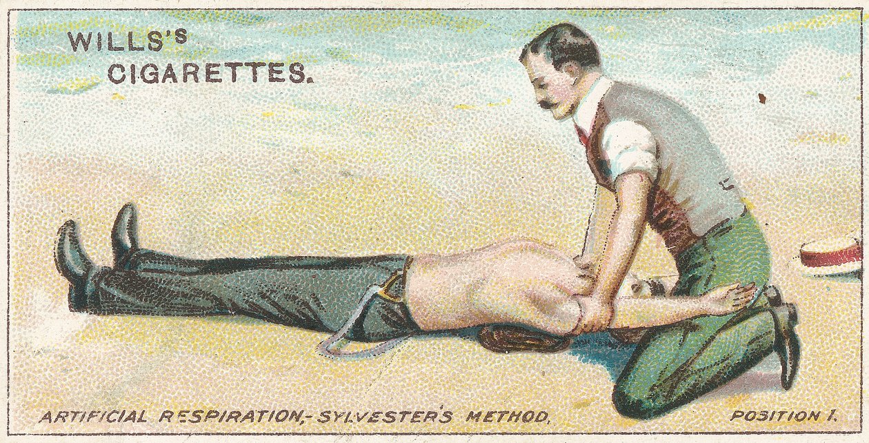 Kunstig åndedrett, Sylvester