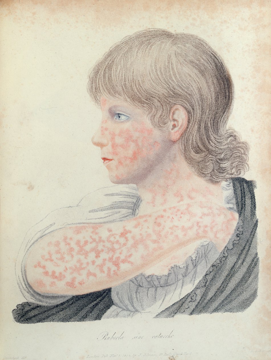 Tyske meslinger, illustrasjon for en bok av Robert Willan (1757-1812), 1808 (fargegravering) av English School