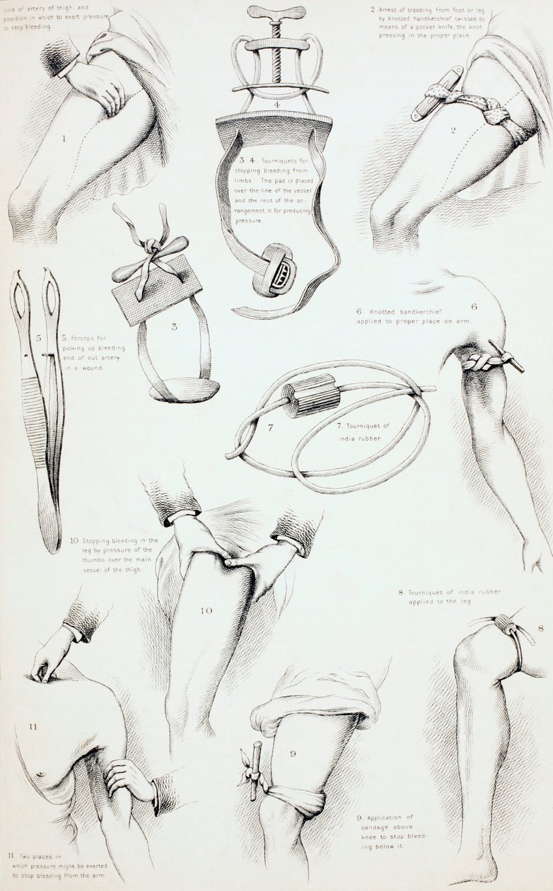 Metoder for å arrestere blødning, ca. 1890 av English School
