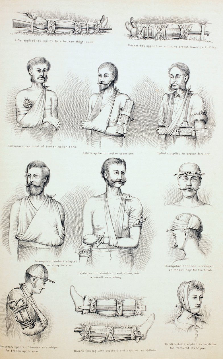 Midlertidig behandling av brudd, ca. 1890 av English School
