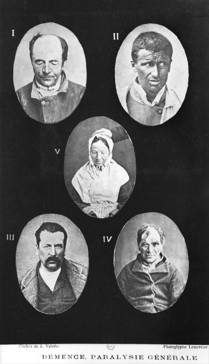 Demens, generell lammelse, illustrasjon fra Ny elementær og praktisk avhandling om psykiske lidelser av Henri Dagonet (1823-1902) Paris, Bailliere, 1876 av French Photographer