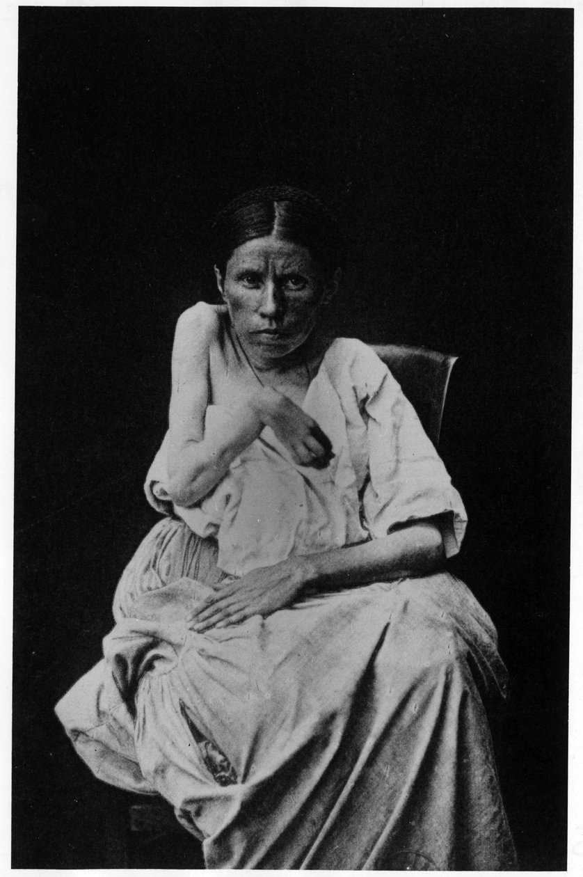 Fotografi av en pasient som lider av hemiplegisk epilepsi, -i "" fotografisk ikonografi av Salpetrière, Bourneville og P. Regnard, Paris av French Photographer
