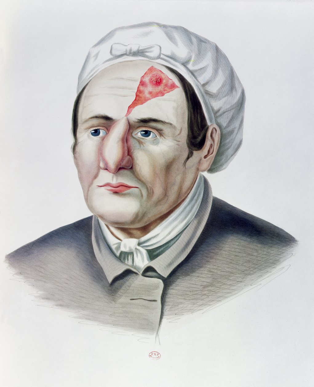 Etter en hudtransplantasjonsoperasjon, fra Selecta Praxis Medico-Chirurgica av Alexander Auvert, Paris, 1856 av French School