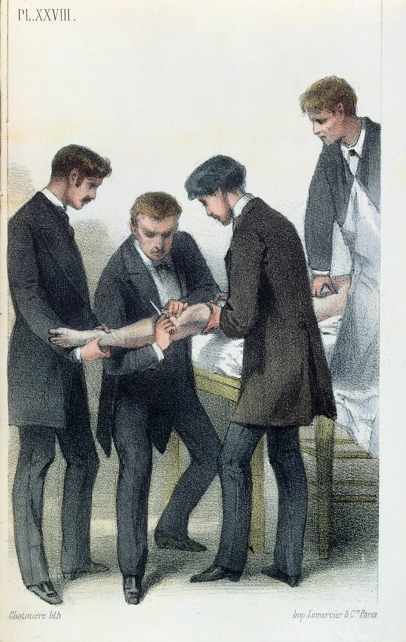 Amputere en arm, fra en medisinsk manual av Jean-Baptiste-Leon Dubreuil, ca. 1850-60 av French School
