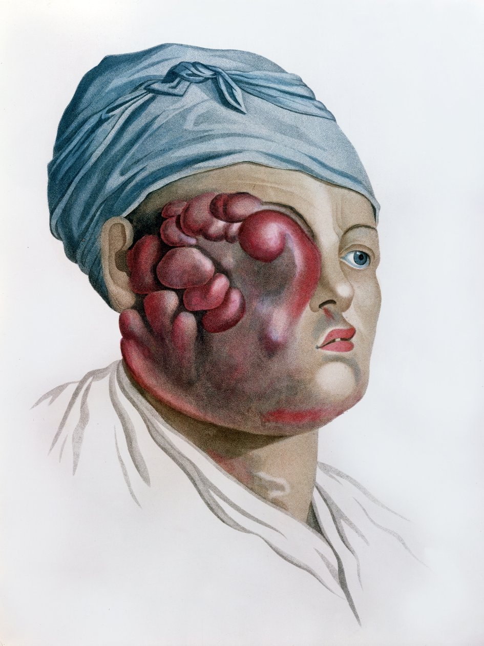 Cancerous scrofula, fra Description des Maladies de la Peau av Baron Jean Louis Alibert (1768-1837) Paris, 1806 av French School