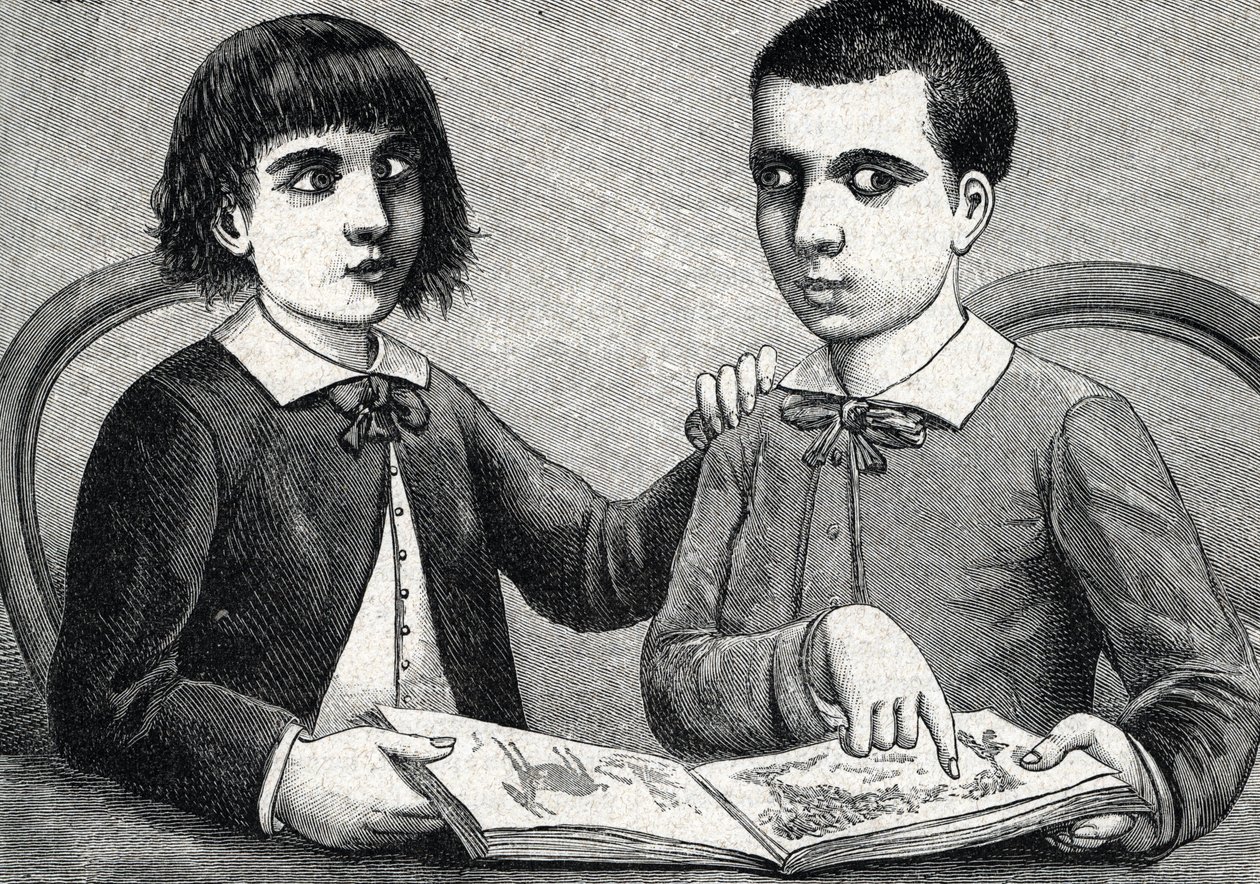 Barn med konvergent og divergerende skjeling eller kryssede øyne (gravering) 1888 av French School