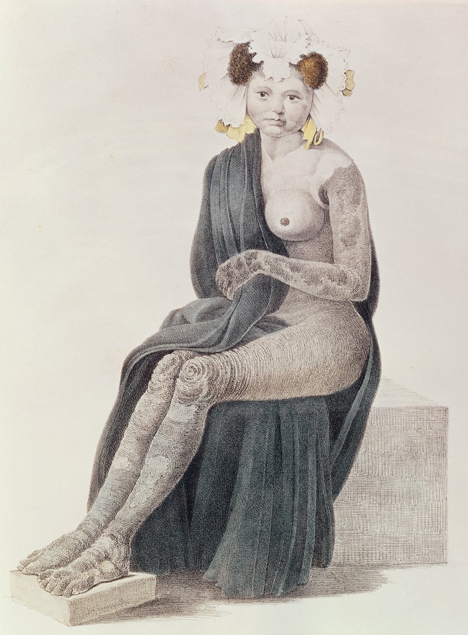 Congenital Ichthyosis, fra en bok av G.M. Olbers, 1830 av French School