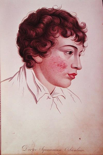 Tørr lapp, fra 'Description des Maladies de la Peau' av baron Jean Louis Alibert (1768-1837) av French School