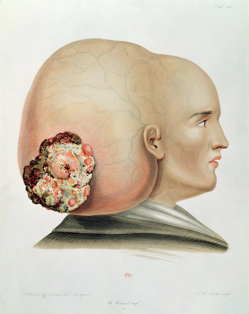 Sopp av dura mater, fra Selecta Praxis Medico-Chirurgica av Alexander Auvert, Paris, 1856 av French School