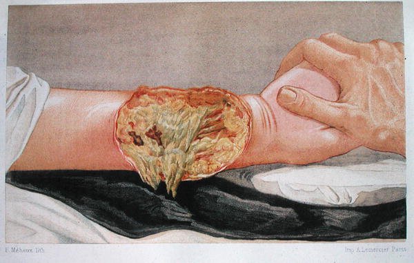 Hospital Gangrene, fra 