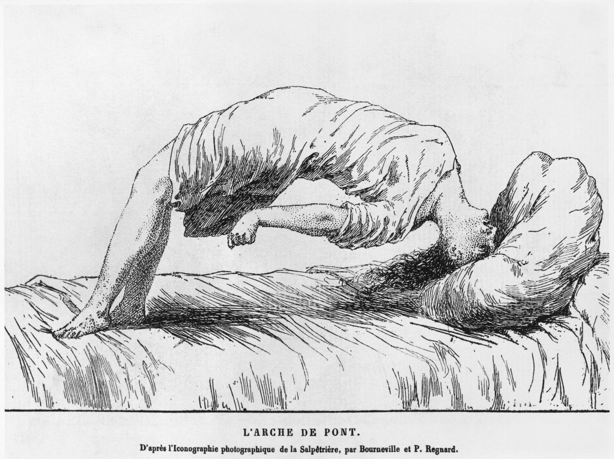 Hysteri og somnambulisme, fra Les Maladies Endemiques de l