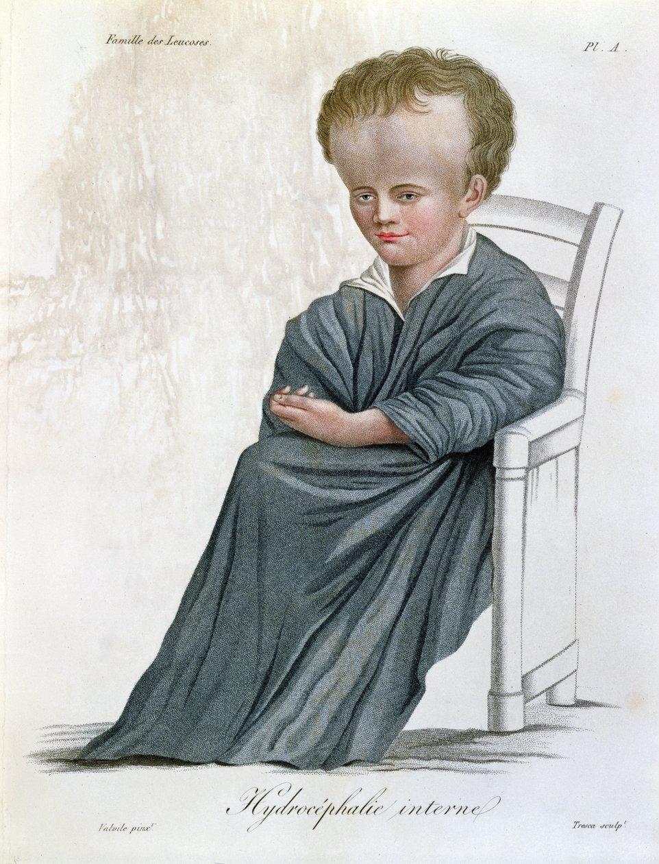 Intern Hydrocephalus, fra Nosologie Naturelle av Baron Jean Louis Alibert (1768-1837) gravert av Tresca, 1817 av French School