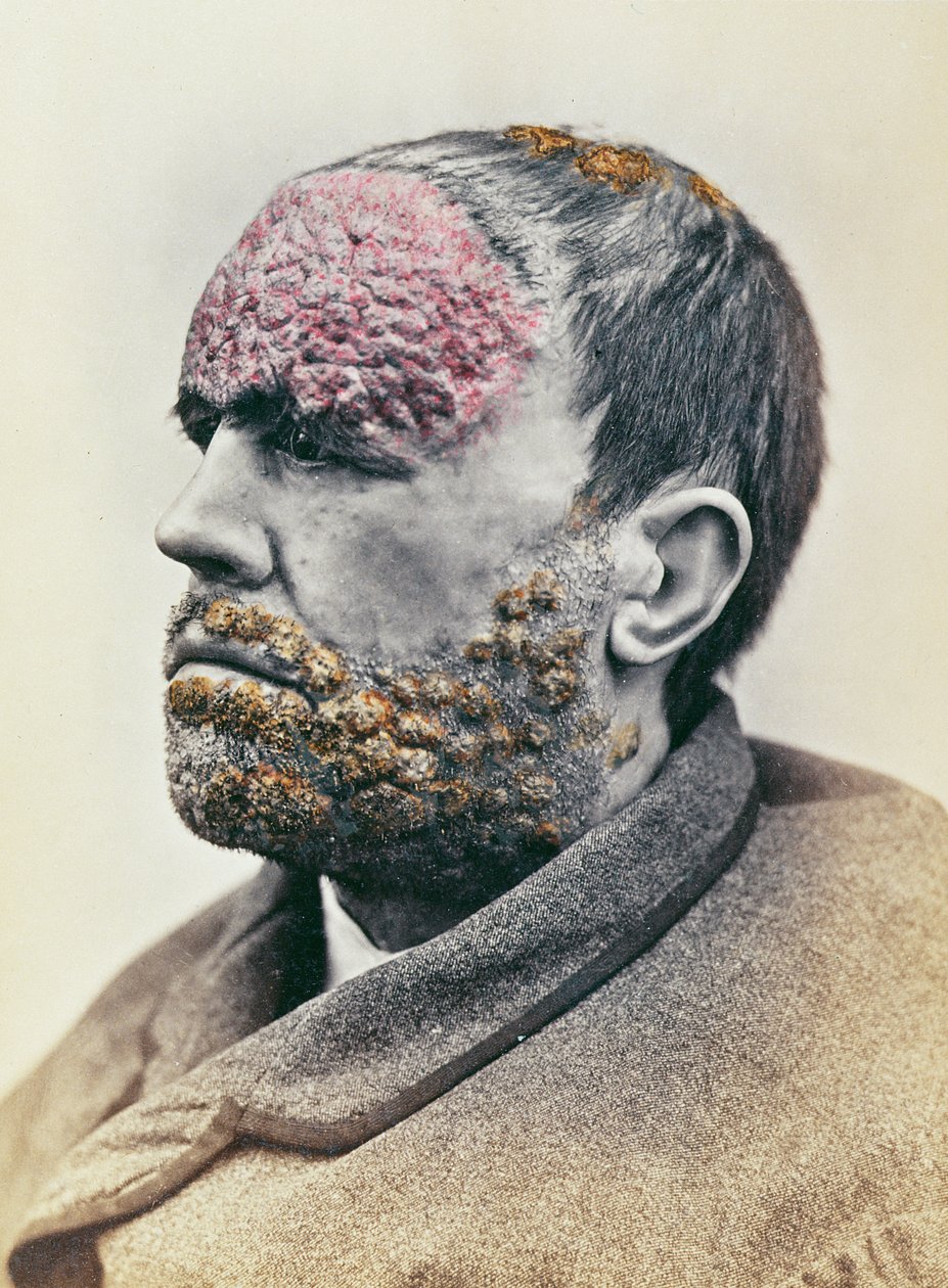 Mann som lider av syfilis, fra et fotografi tatt for Clinique Photographique de l