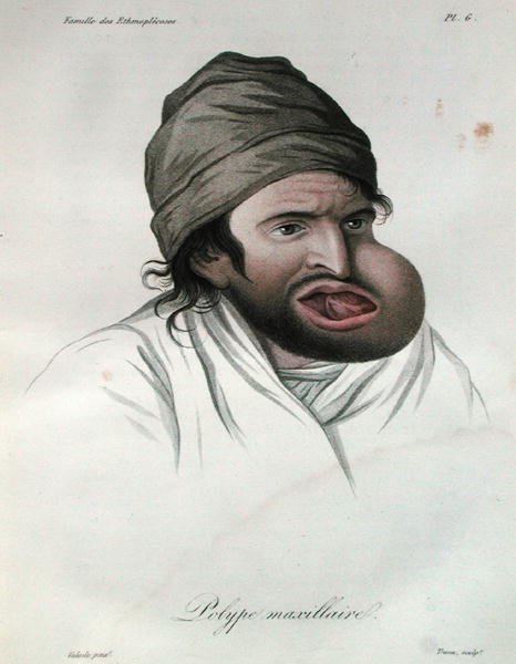 Kjevepolypp, fra en bok av Baron Jean Louis Alibert (1768-1837) 1817 (farget gravering) av French School