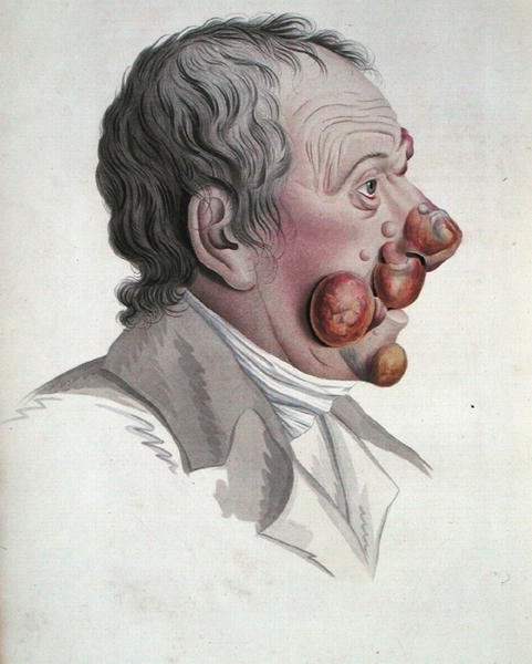 Mycosis Fongoide, fra en bok av Baron Jean Louis Alibert (1768-1837) 1838 (farget gravering) av French School