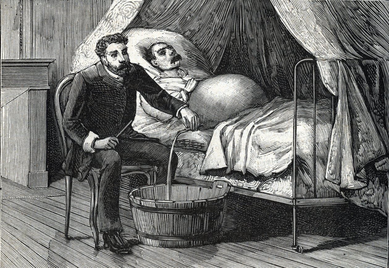 Pasient med avansert levercirrhose, lege som utfører en punktering (gravering) 1888 av French School