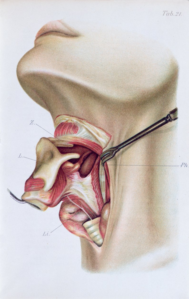 Plate fra Atlas and Epitome of Operative Surgery av Dr. Otto Zuckerkandl (1861-1921) 1910 av French School