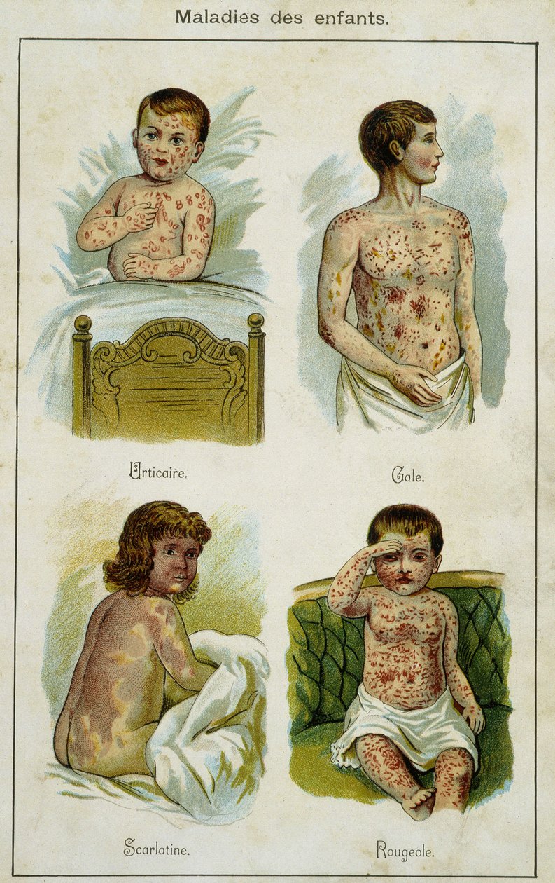 Tallerken som illustrerer barnesykdommer: elveblest, skabb, skarlagensfeber og meslinger (trekk fra Bilz, naturlig medisin) sent på 1800-tallet. av French School