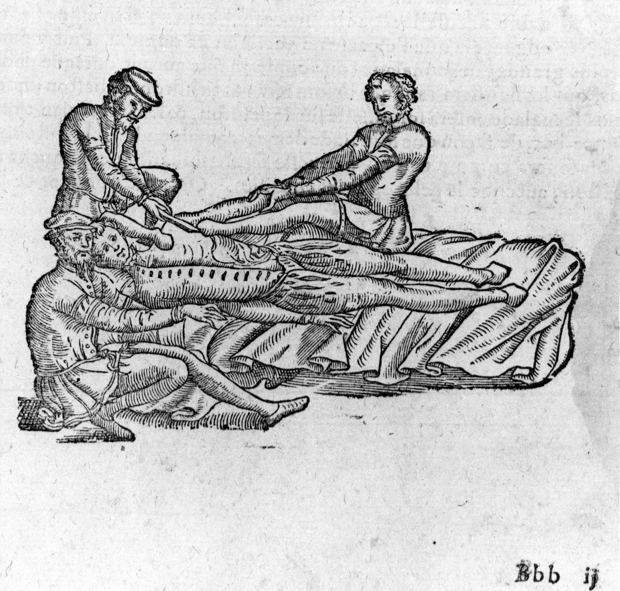 Reduksjon av en dislokasjon, -i "Medical Treatise of Ambroise Paré", ca 1560. av French School