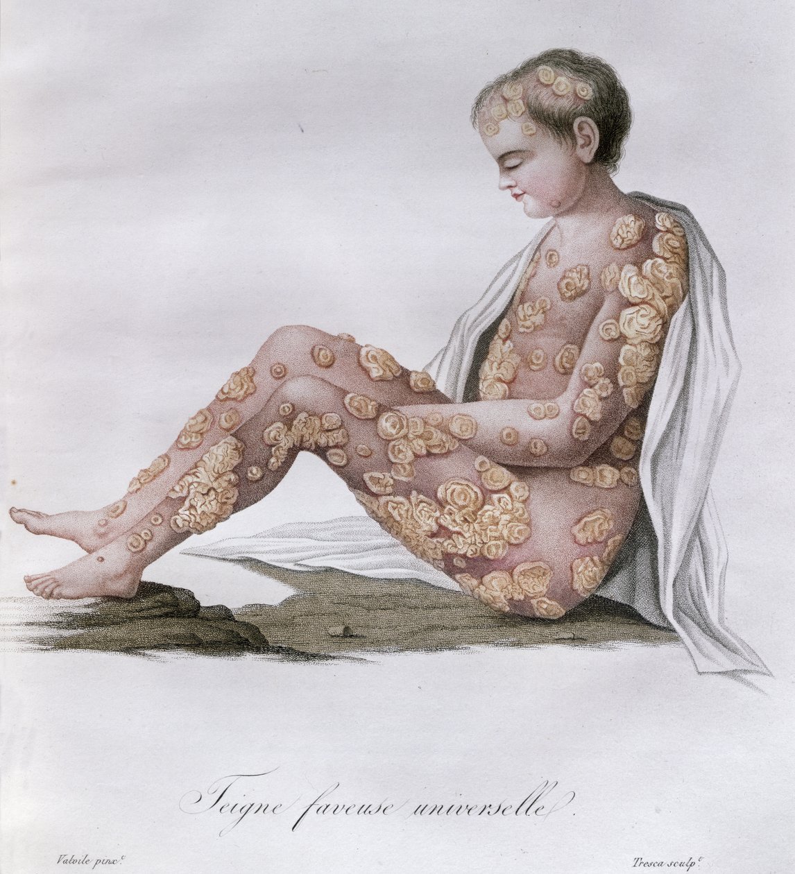 Ringorm, fra en bok av Baron Jean Louis Alibert (1768-1837) 1838 av French School