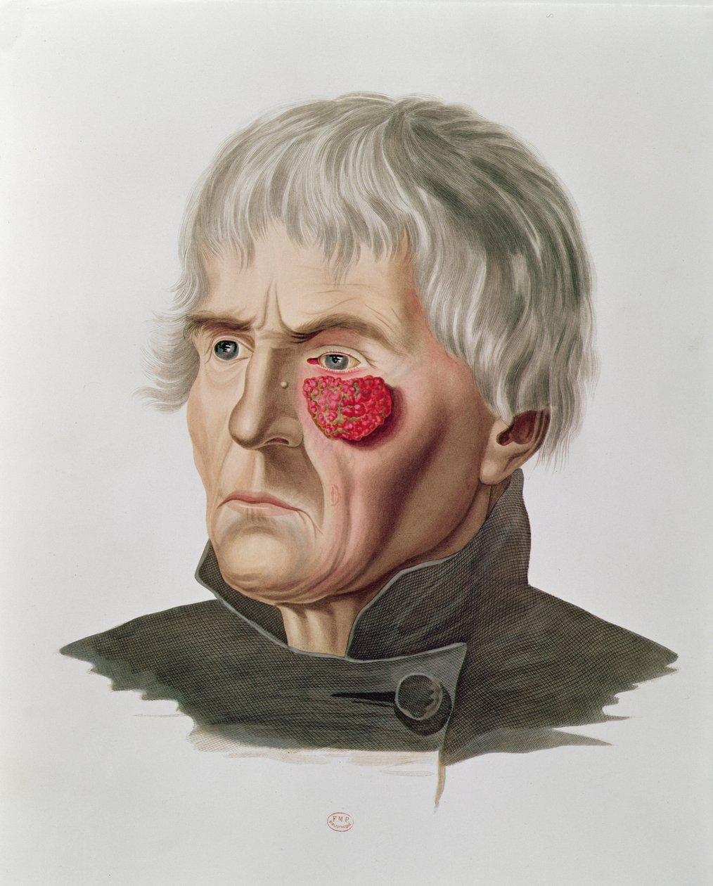 Hudsykdom før en operasjon, fra Selecta Praxis Medico-Chirurgica av Alexander Auvert, Paris, 1856 av French School