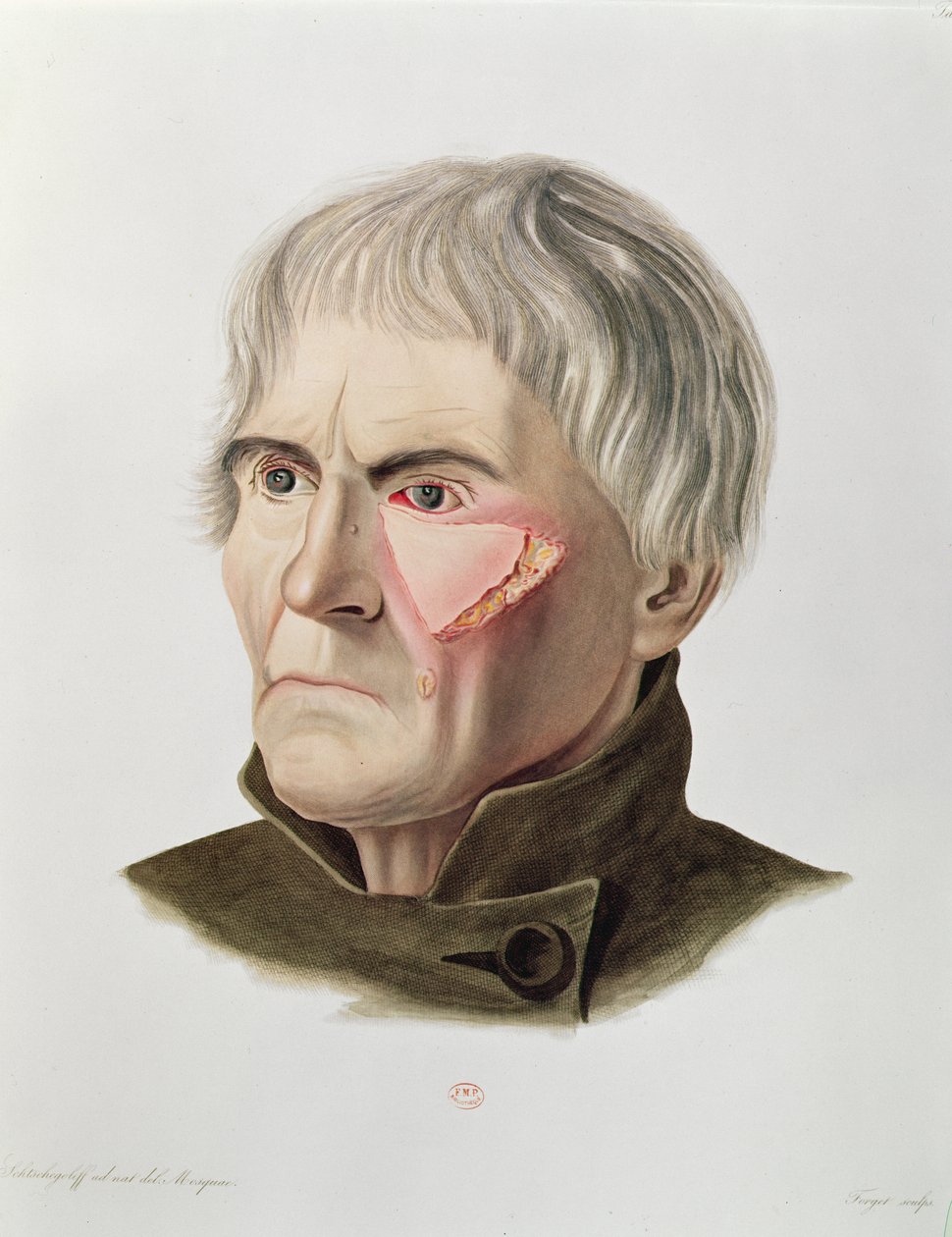 Hudtransplantasjonsoperasjon, fra Selecta Praxis Medico-Chirurgica av Alexander Auvert, Paris, 1856 av French School