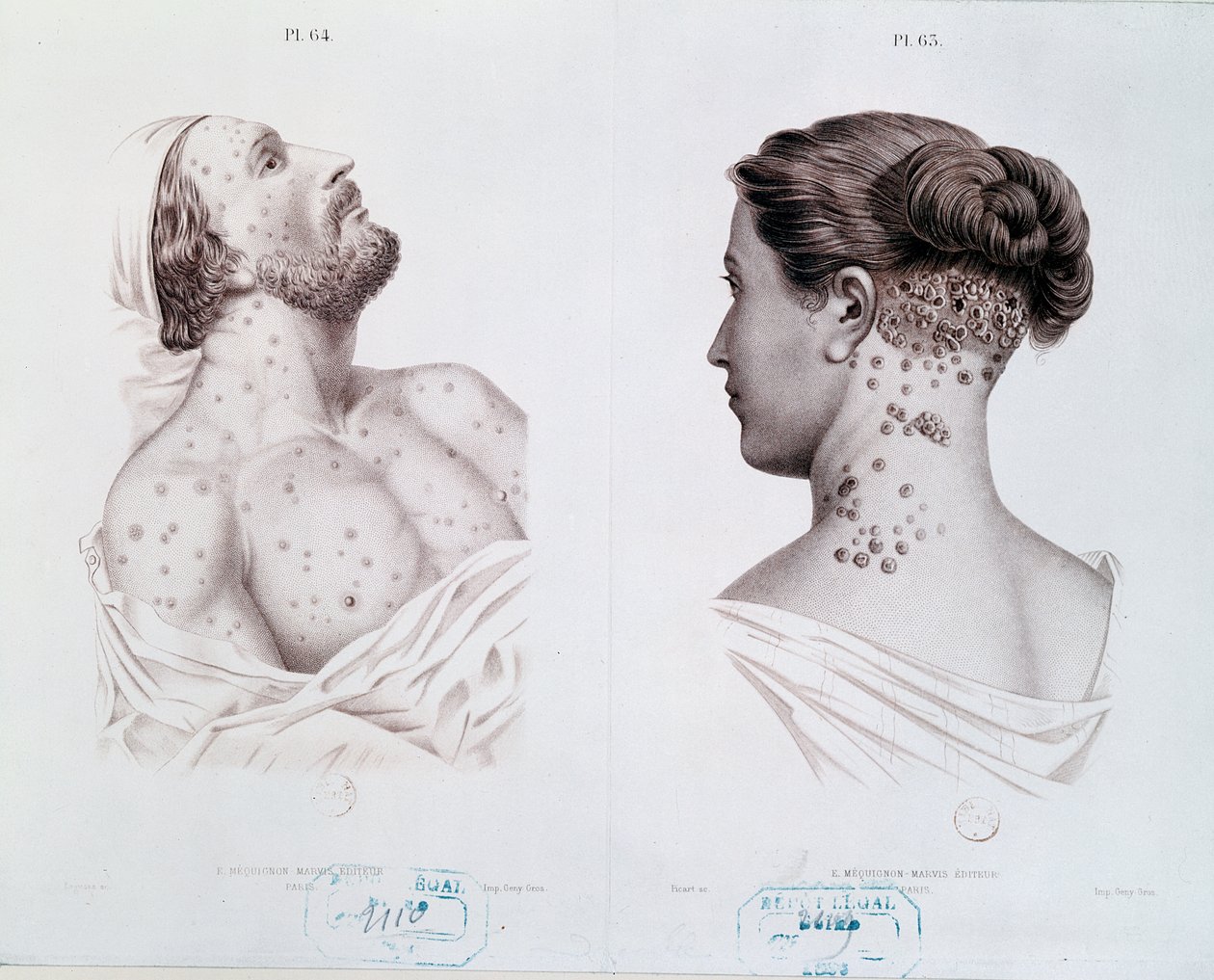Symptomer på syfilis hos menn og kvinner, fra en medisinsk bok, ca. 1850-60 av French School