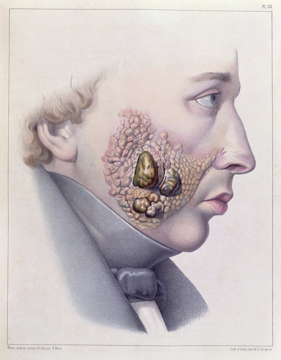 Ansiktssymptomene på kjønnssykdom, fra Traite Complet des Maladies Veneriennes av Philippe Ricord (1800-89) 1851 av French School