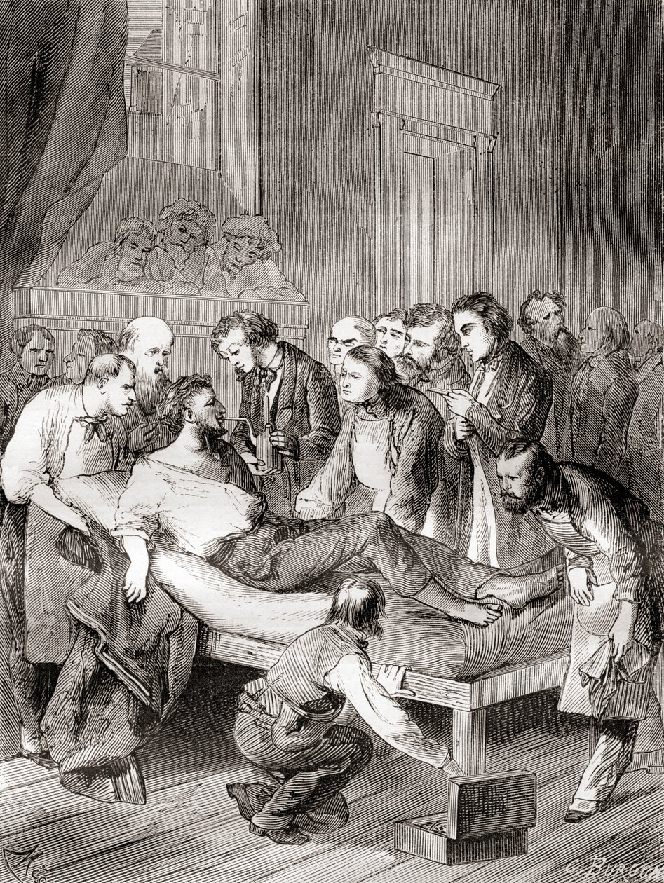 Den første offentlige demonstrasjonen av bruken av inhalert eter som et kirurgisk bedøvelsesmiddel i 1846 av en amerikansk tannlege, William Thomas Green Morton, fra 'Les Merveilles de la Science', publisert ca. 1870 av French School