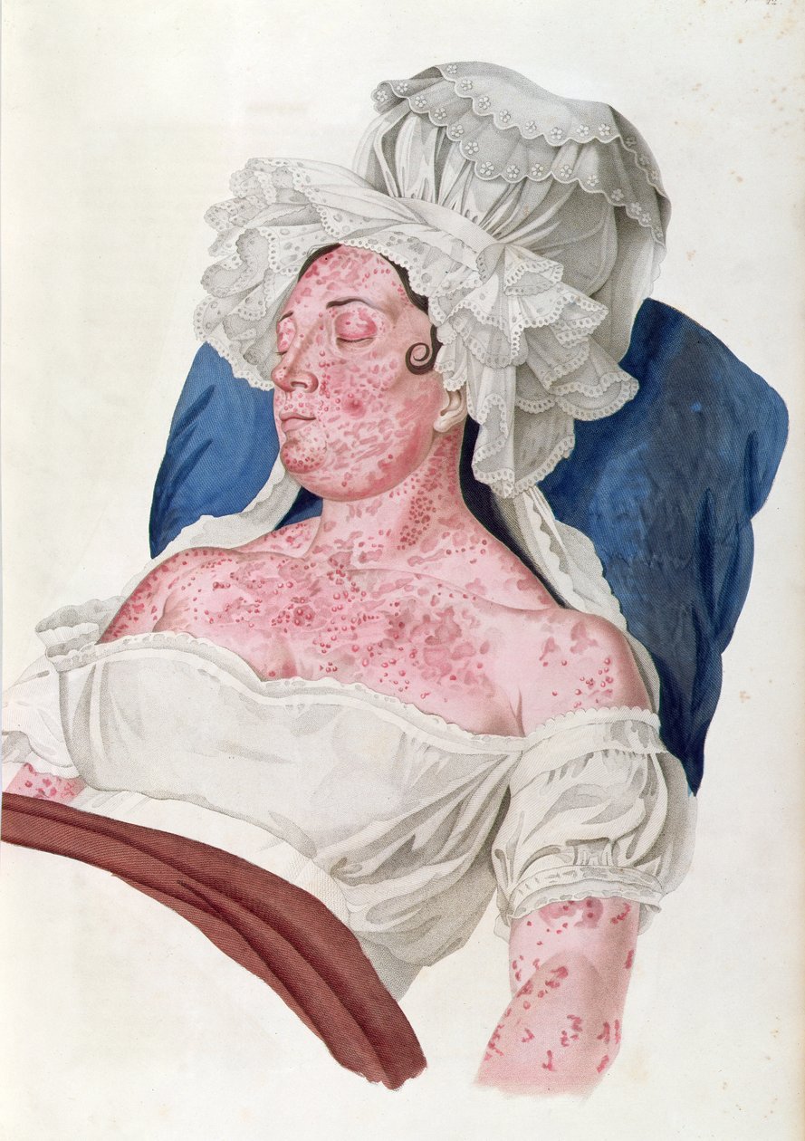 Kvinne med skarlagensfeber, fra en bok av Baron Jean Louis Alibert (1768-1837) gravert av Choupard, 1833 av French School