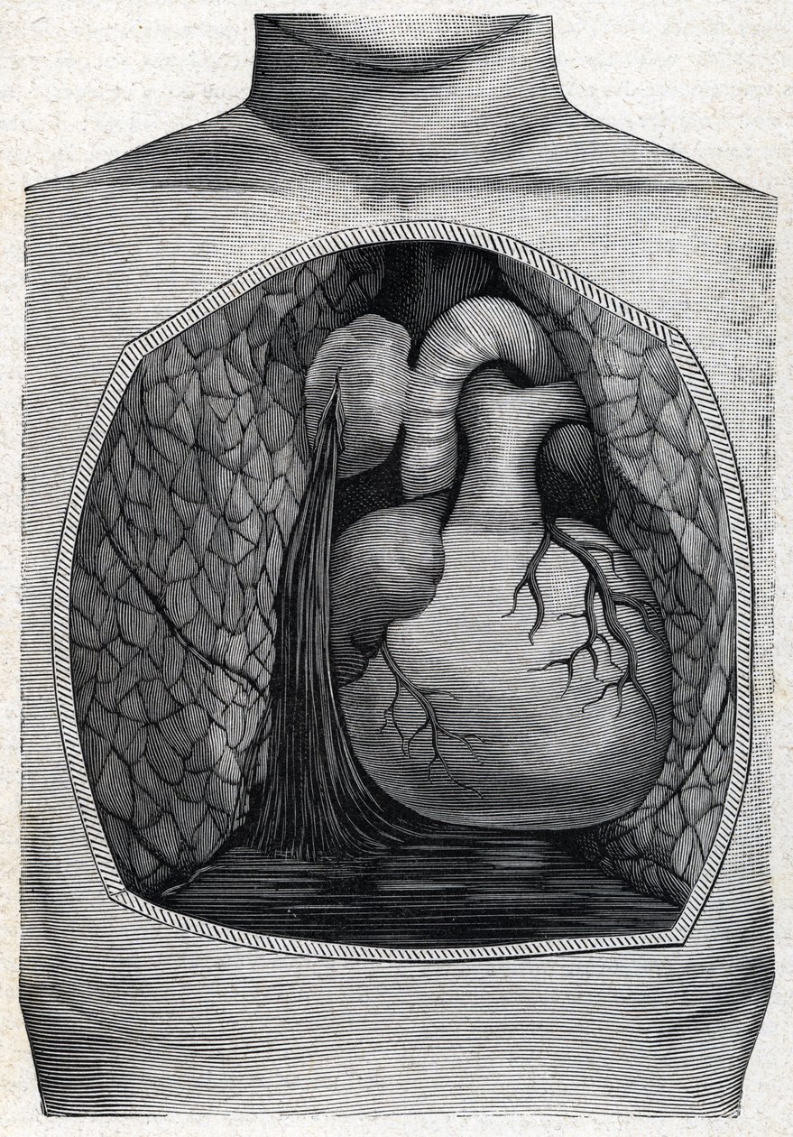 aneurismeruptur (gravering) 1888 av French School