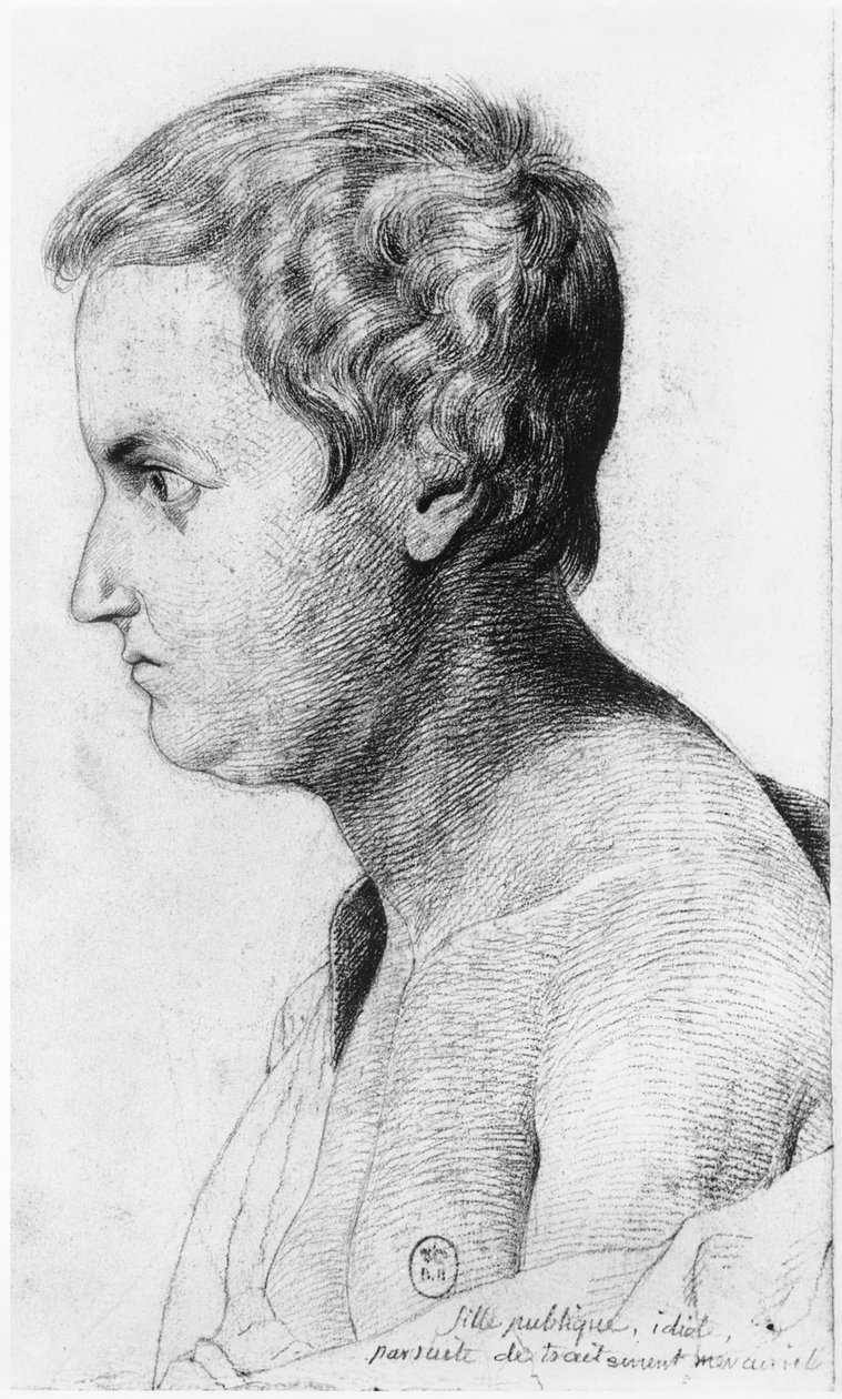 Idiotisk prostituert som lider av syfilis, illustrasjon fra en upublisert avhandling av Jean Etienne Dominique Esquirol (1772-1840) om galningene på Salpetriere-asylet, ca. 1818 av Georges Francois Gabriel