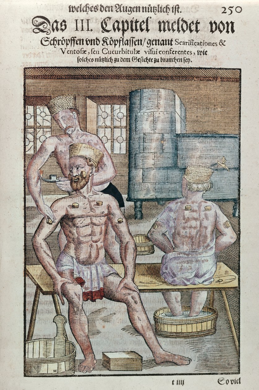 Cupping, fra Ophthalmodouleia av Georg Bartisch (1535-1636) utgitt i Dresden i 1583 (farget treblokktrykk) av German School