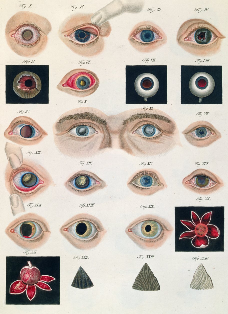 Beskrivelse av medfødte øyeanomalier, fra kliniske presentasjoner av sykdommer og visuelle defekter i det menneskelige øyet, av Friedrich August von Ammon (1799-1861) 1838 av German School
