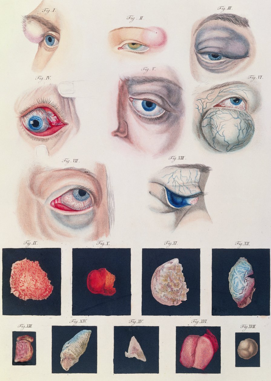 Beskrivelse av medfødte øyeanomalier, fra kliniske presentasjoner av sykdommer og visuelle defekter i det menneskelige øyet, av Friedrich August von Ammon (1799-1861) 1838 av German School